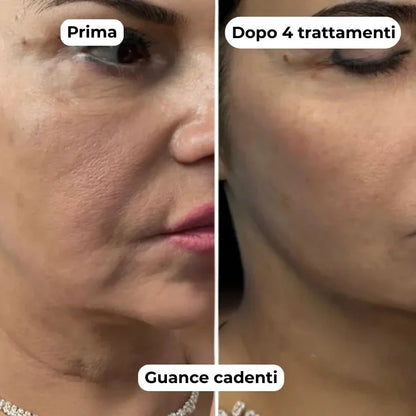 MicroGlow - Trattamento ad Infusione Cutanea